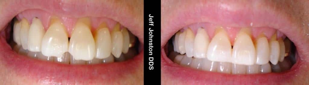 Chipped Tooth Repair Cherry Creek, Denver