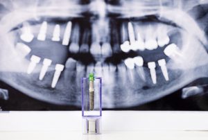 Dental Arch Implants - Cherry Creek, Denver