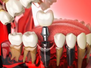 Dental Implants Cherry Creek, Denver