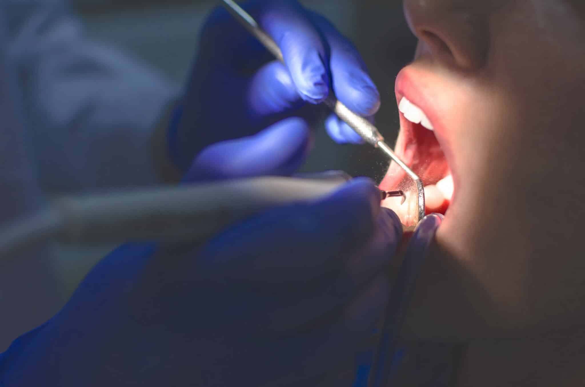 what-to-expect-from-a-deep-teeth-cleaning-ascent-dental-group